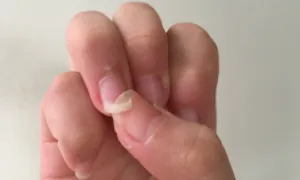 Trắc nghiệm để biết bạn có nguy cơ ung thư da không Trắc nghiệm để biết bạn có nguy cơ ung thư da không