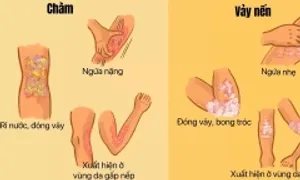 Chàm và vảy nến khác nhau thế nào Chàm và vảy nến khác nhau thế nào