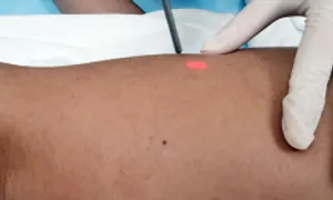 Phương pháp điều trị tàn nhang, nám má Phương pháp điều trị tàn nhang, nám má
