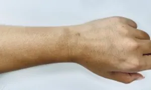 Ai có nguy cơ ung thư da? Ai có nguy cơ ung thư da?