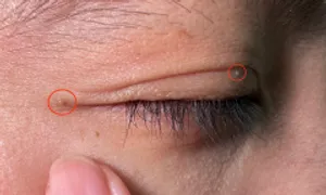 Xóa mụn thịt dư bằng kem tẩy nốt ruồi được không? Xóa mụn thịt dư bằng kem tẩy nốt ruồi được không?
