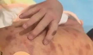 Bé sơ sinh bị tăng sinh tế bào mast Bé sơ sinh bị tăng sinh tế bào mast